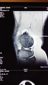Povreda kolena - povreda meniskusa